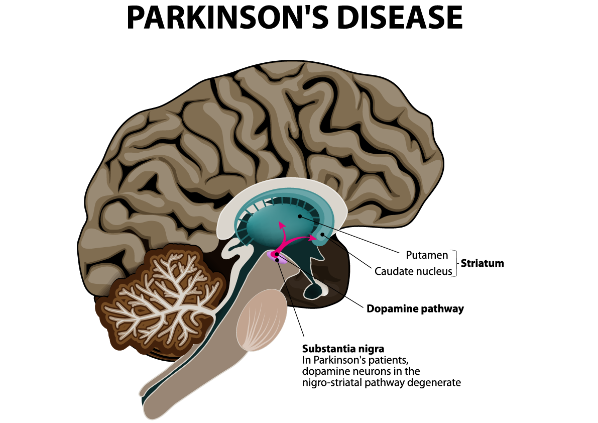 Brain in Parkinson's disease